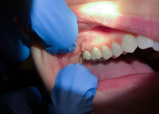 Best Emergency Wisdom Teeth Removal in Mangum, OK